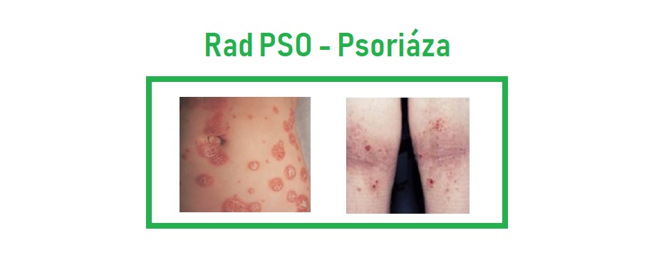 psoriaza sk